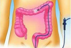 肠镜怎么做的过程视频,直观视频带你了解每一步